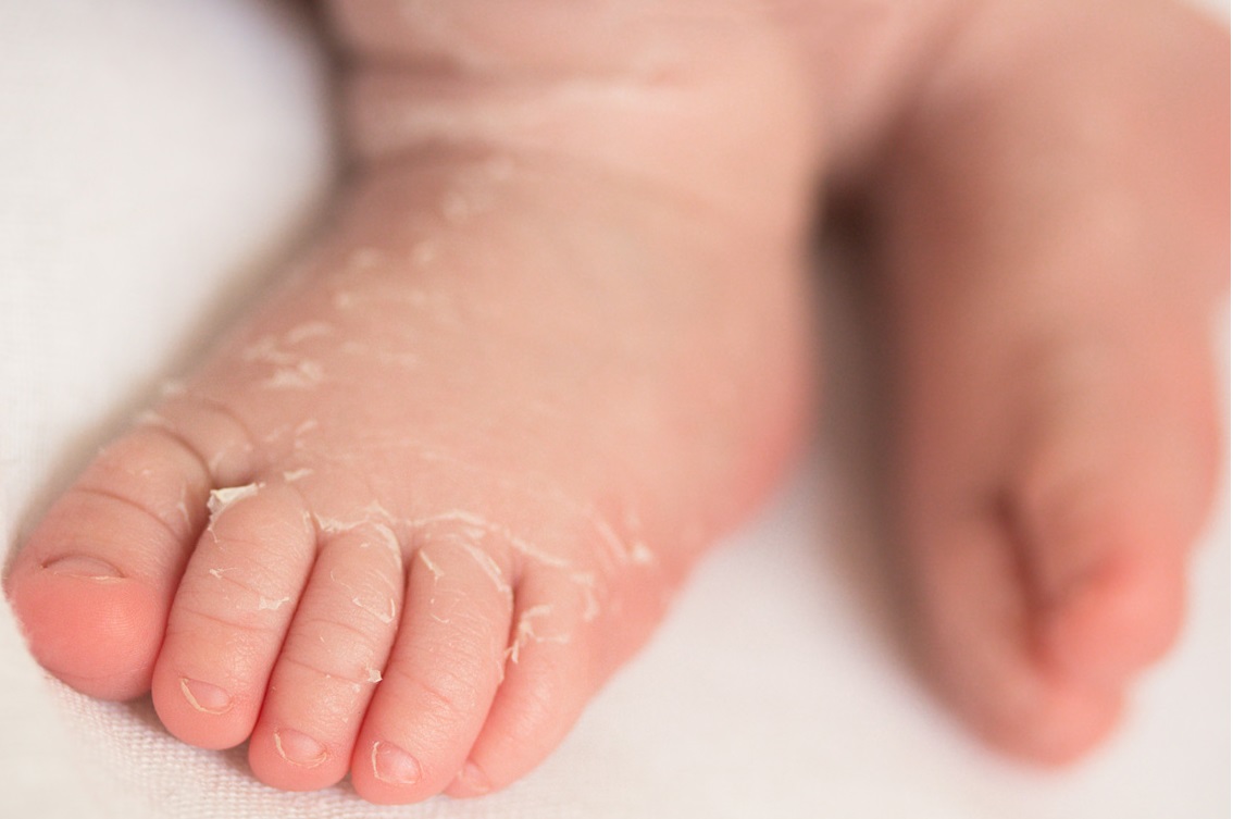 Why Does My Newborn Have Rashes